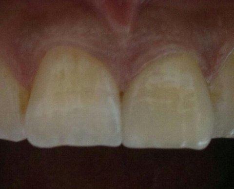 Frattura del dente 2.1 dopo - Corona in zirconio 2.1 dopo