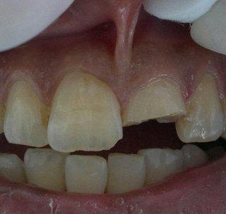 Frattura del dente 2.1 prima