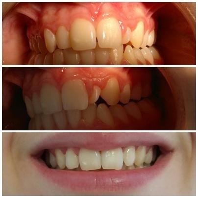 Ortodonzia 1 prima e dopo