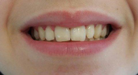 Ortodonzia 3 prima e dopo