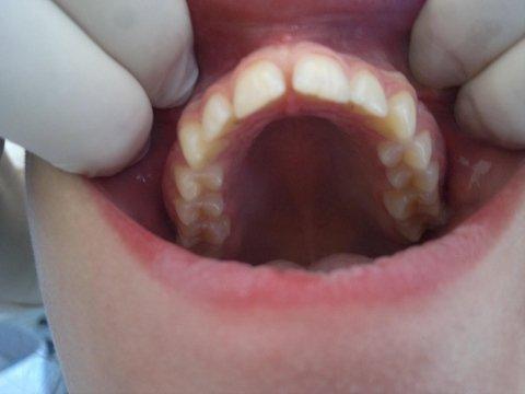 Ortodonzia invisibile 2 Prima e dopo