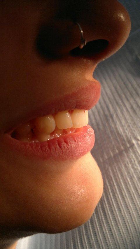 Ortodonzia invisibile 3 Prima e dopo